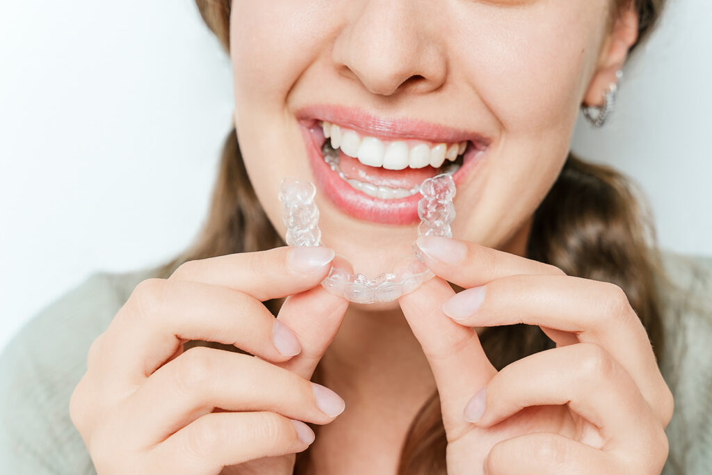 Primo piano di una donna sorridente che inserisce un allineatore trasparente in bocca, raddrizzamento dei denti e sorriso perfetto